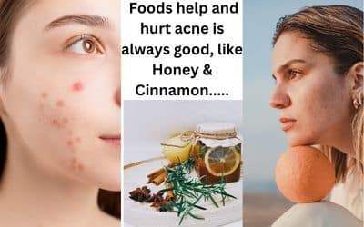 foods help and hurt acne